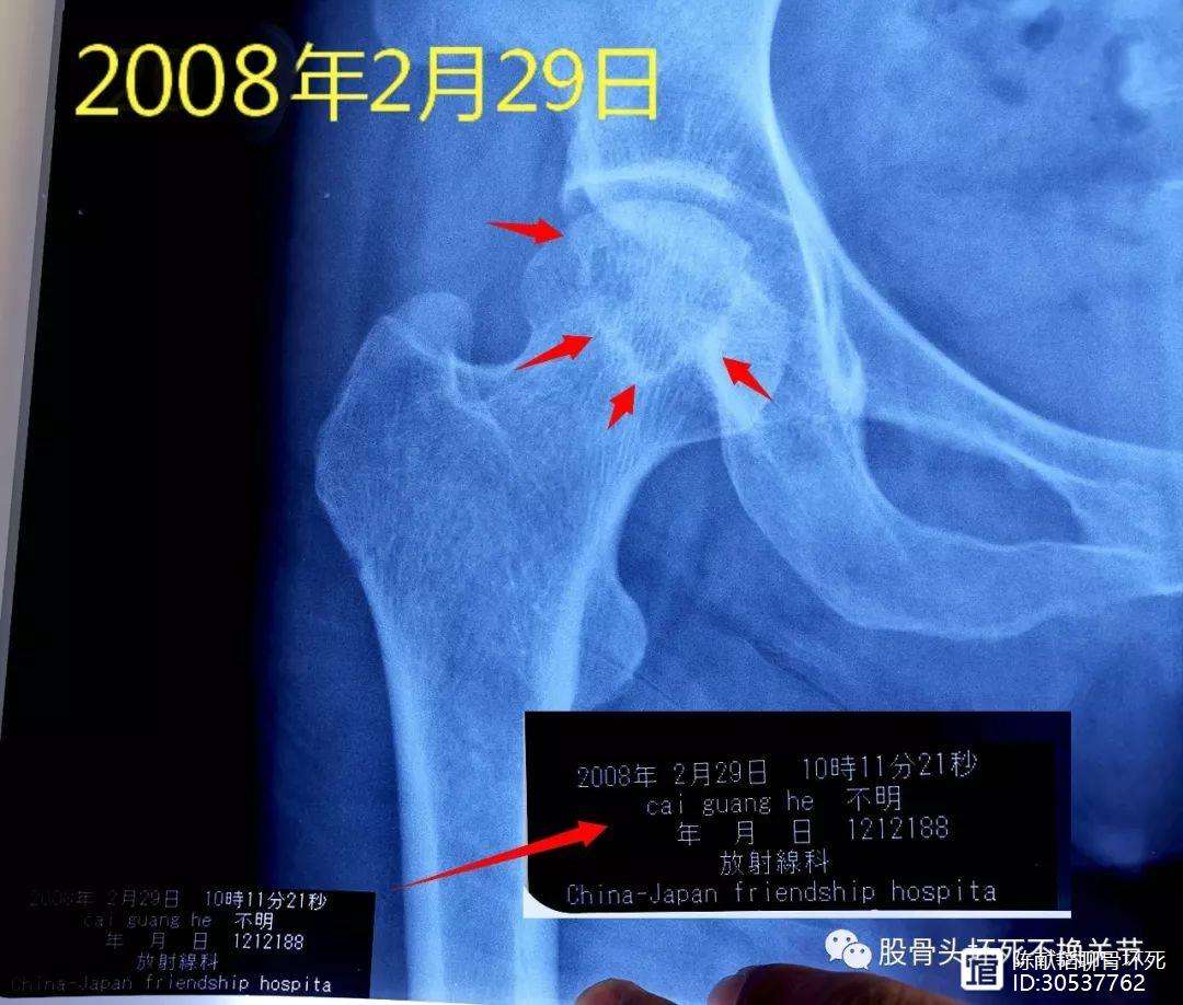 贺州人工骨头医保报销多少(人工骨头医保报销多少比例)